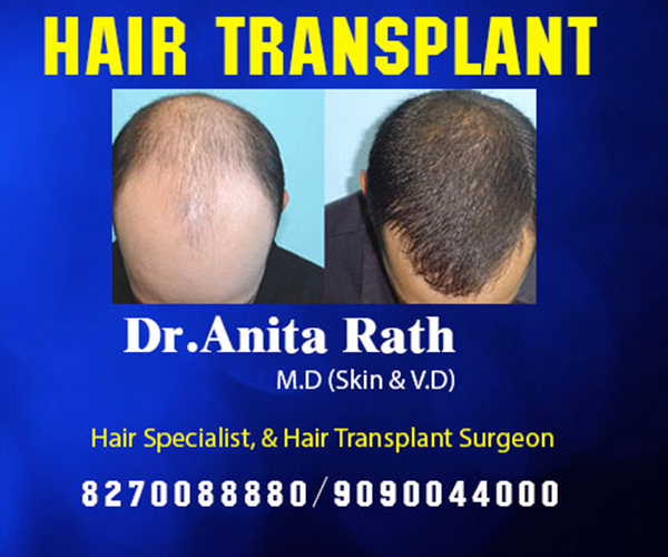 best hair transplant clinic in bhubaneswar near capital hospital